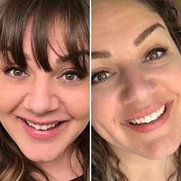Ashley H. — 6 months | Crowding Ashley H. — 6 months | Crowding