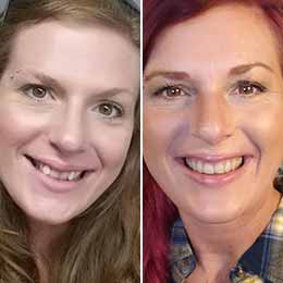 Amy D. — 7 months | Protrusion Amy D. — 7 months | Protrusion