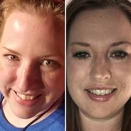 Hilary S. — 10 months | Protrusion Hilary S. — 10 months | Protrusion