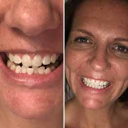 Katie K. — 8 months | Crowding Katie K. — 8 months | Crowding