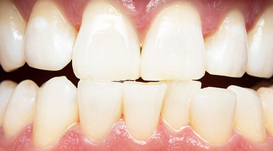 After Zoom!® WhiteSpeed Teeth Whitening