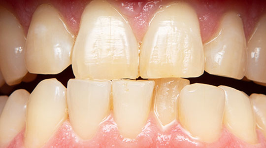 Before Zoom!® WhiteSpeed Teeth Whitening